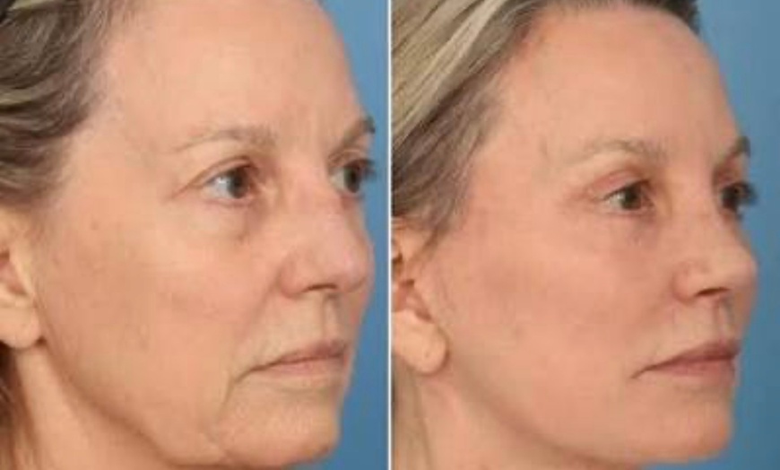 Image 4: Enhance  with Half / Full Syringe of Lip Filler or LIQUID FACELIFT 
