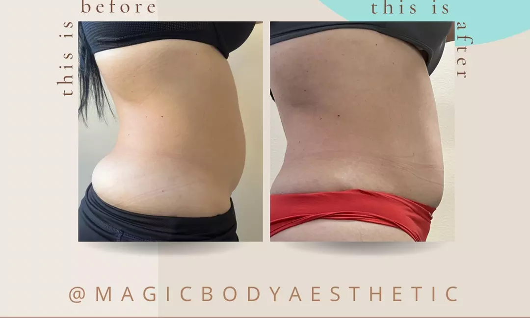 Up to 60% Off on Ultrasonic Fat Reduction at Magic Body Aesthetic