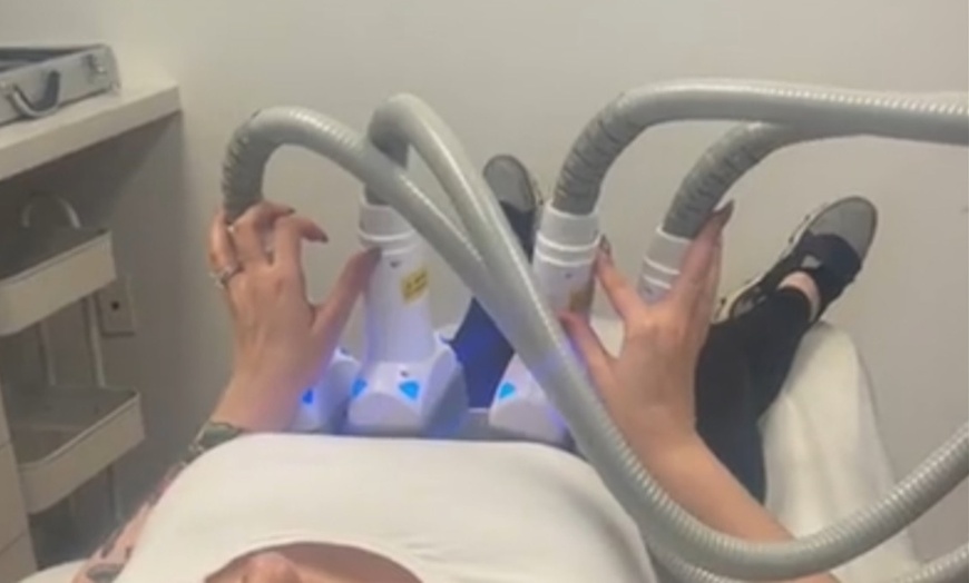 Image 3: Fat Reduction Treatment for UnderChin, Abdomen, or Inner Thigh 