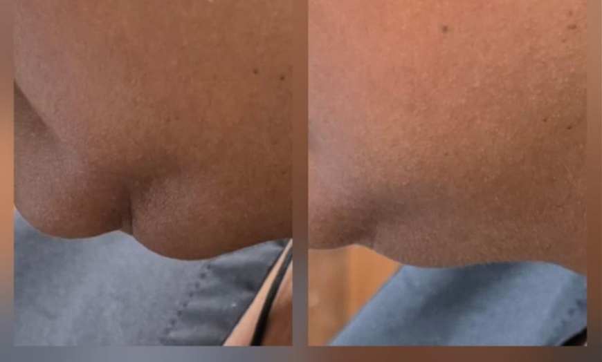 Image 3: Transform with HIFU Treatment on Neck, Half or Full Face or Body 
