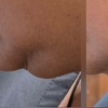 Image 3: Transform with HIFU Treatment on Neck, Half or Full Face or Body 