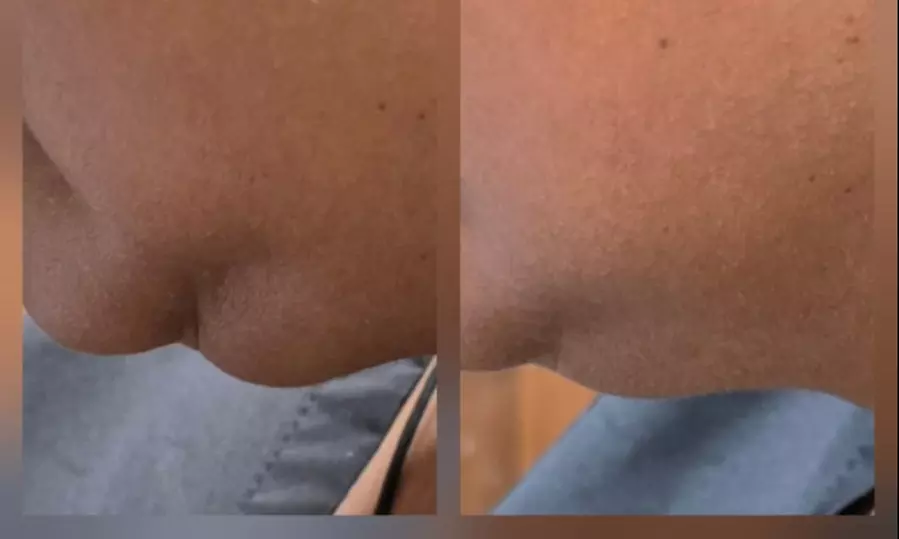 Transform with HIFU Treatment on Neck, Half or Full Face or Body