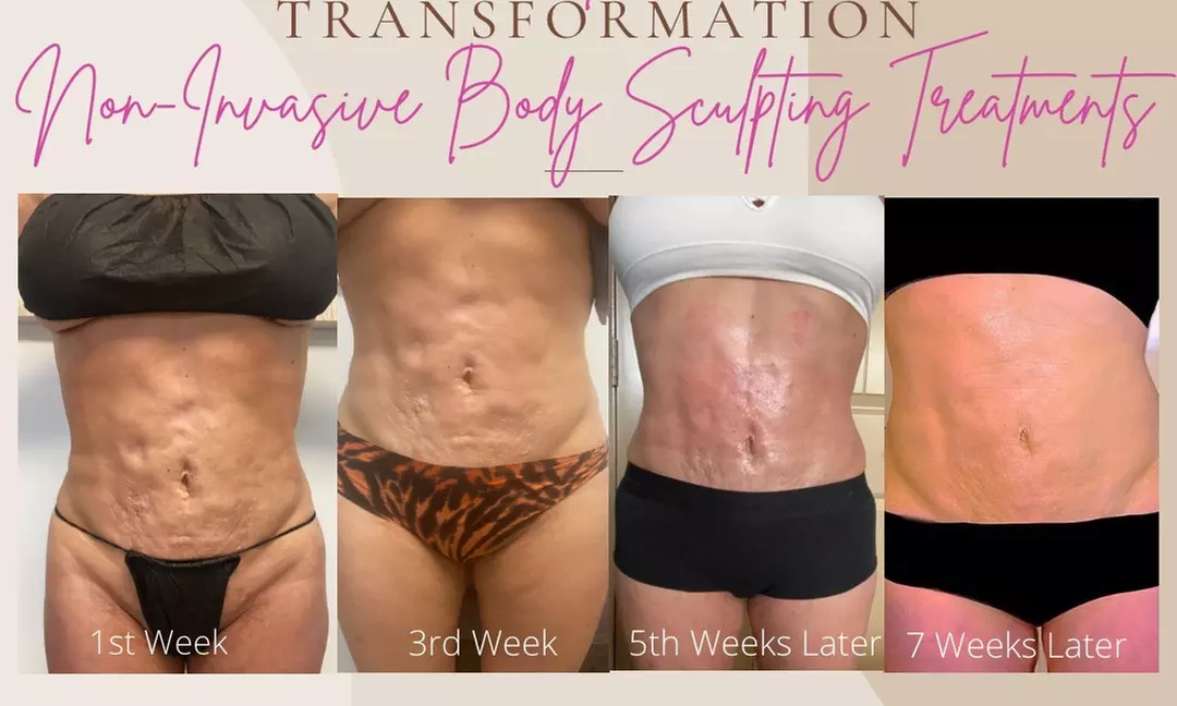 Achieve Your Body Goals with Treasure the Moment's Five-in-One Packages, including Cavitation and More, up to 39% Off - Primary Image
