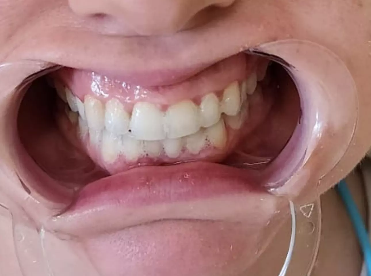 Brighten Your Smile with One Teeth Whitening Treatment