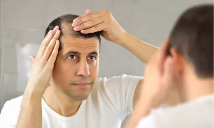 Up to 52% Off on Hair Restoration - Non-Surgical at Advanced Stem Cell Institute - Primary Image