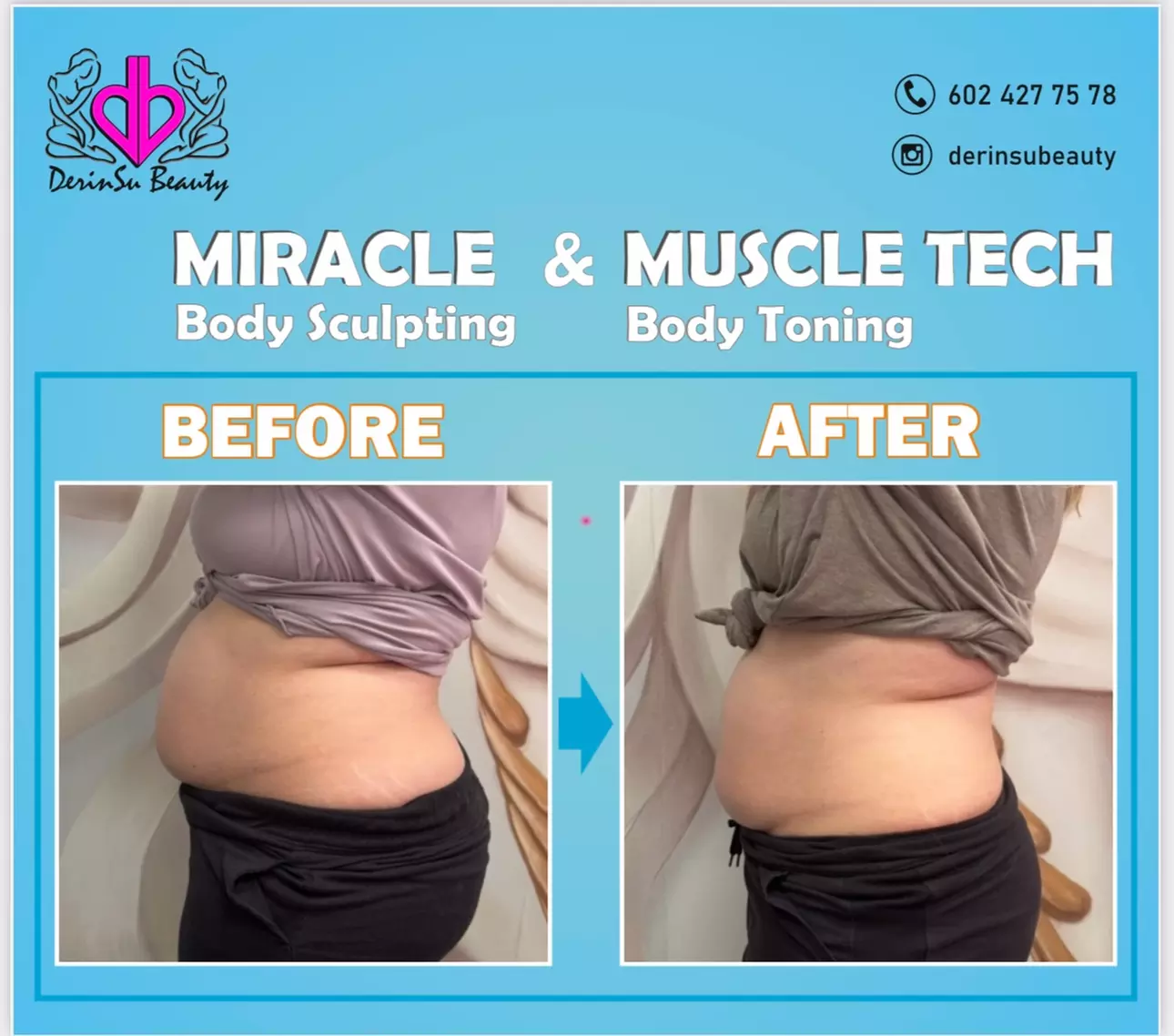 Up to 78% Off on Fat Reduction - Non-Branded at Derinsu Beauty - Second Medium