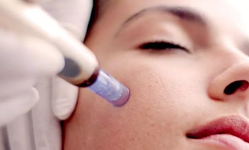 Image 1: Save up to 72% on Micro-needling at The Laser Lab