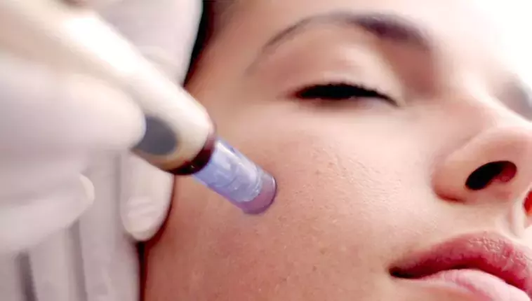 Save up to 72% on Micro-needling at The Laser Lab  - Primary Image