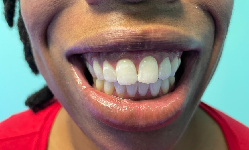 Image 2: Teeth Whitening - In-Office at Spoiled Goddess & King Detox