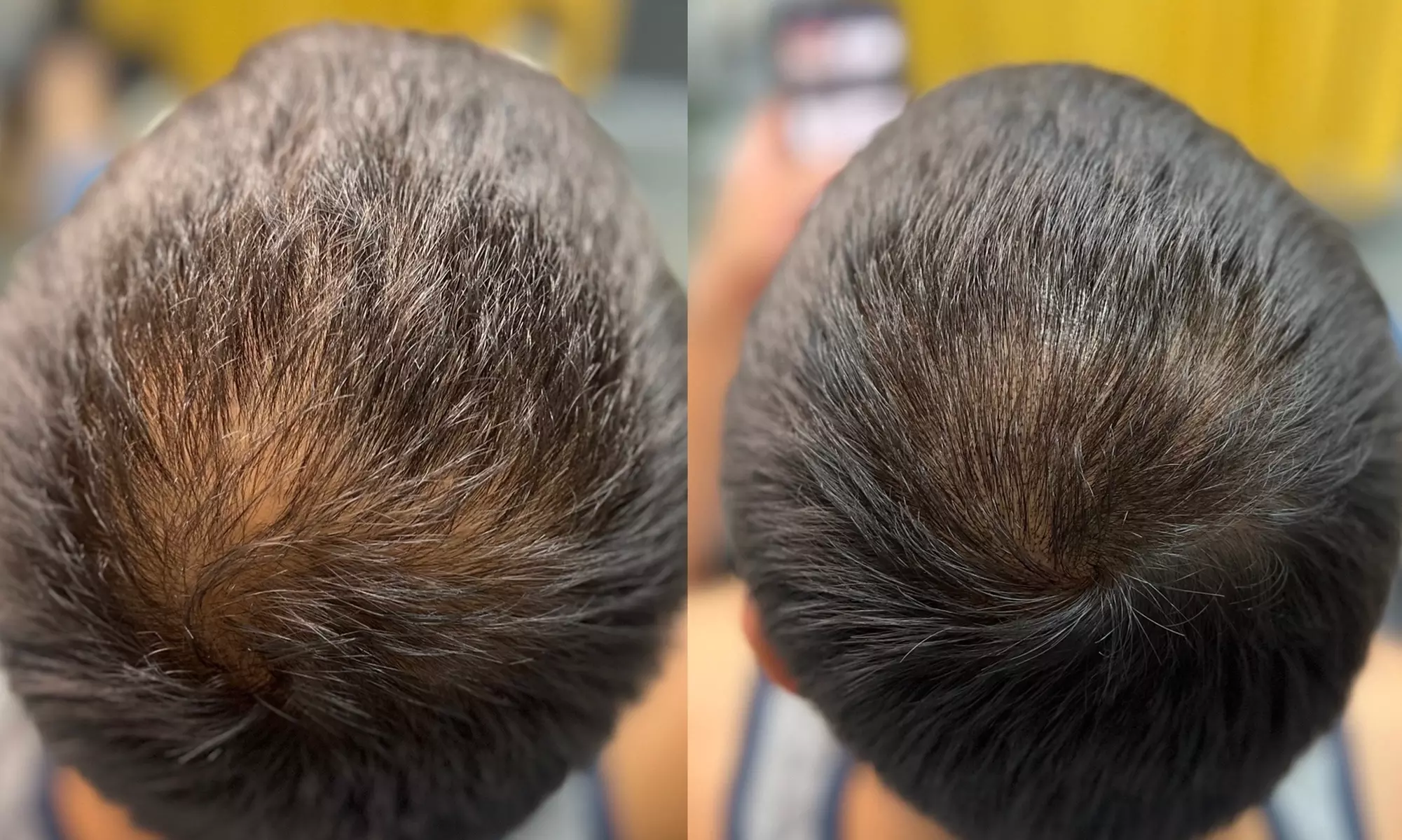 Transform Your Look with Hair Restoration Magic! Micropigmentation