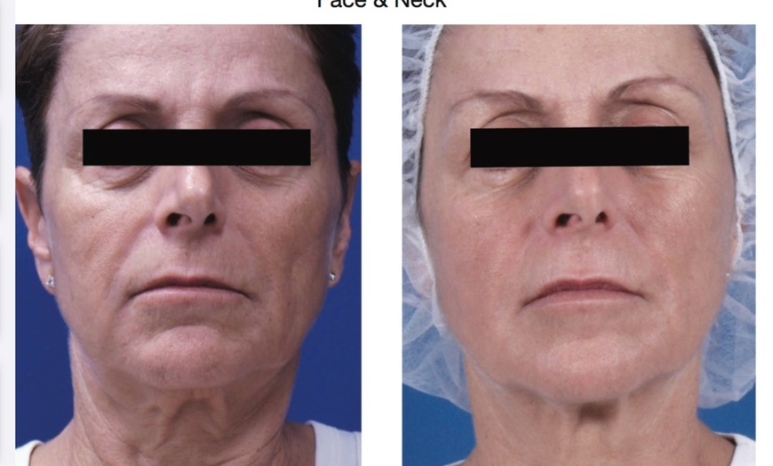 Image 1: Up to 60% Off on Radio Frequency Skin Tightening at Sculpting Beauty by Pam