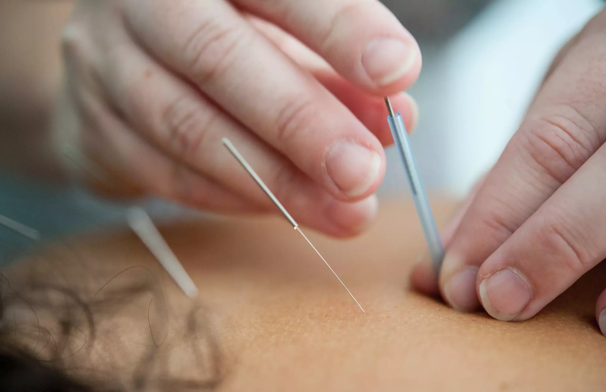 Up to 80% Off on Acupuncture and Cupping at Core Meridian