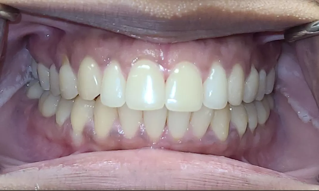 Up to 88% Off on Invisalign at Murphy Dental Group - Second Medium