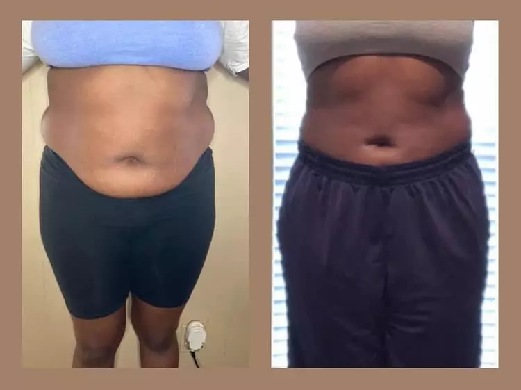 Up to 10% Off on Fat Reduction - Non-Branded at The Unicorn Body Sculpting - Primary Image