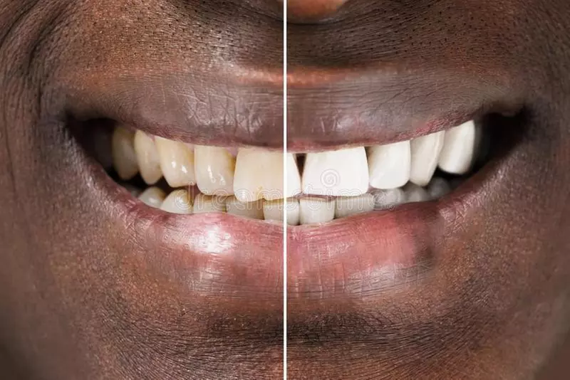 Experience Smile Fairy Spa's teeth whitening with various options and up to 50% off - Second Medium