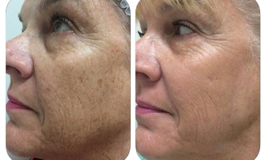 Image 1: Up to 43% Off on IPL-Intense Pulse Light Therapy at Aesthetics Care Med Spa