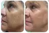Up to 43% Off on IPL-Intense Pulse Light Therapy at Aesthetics Care Med Spa