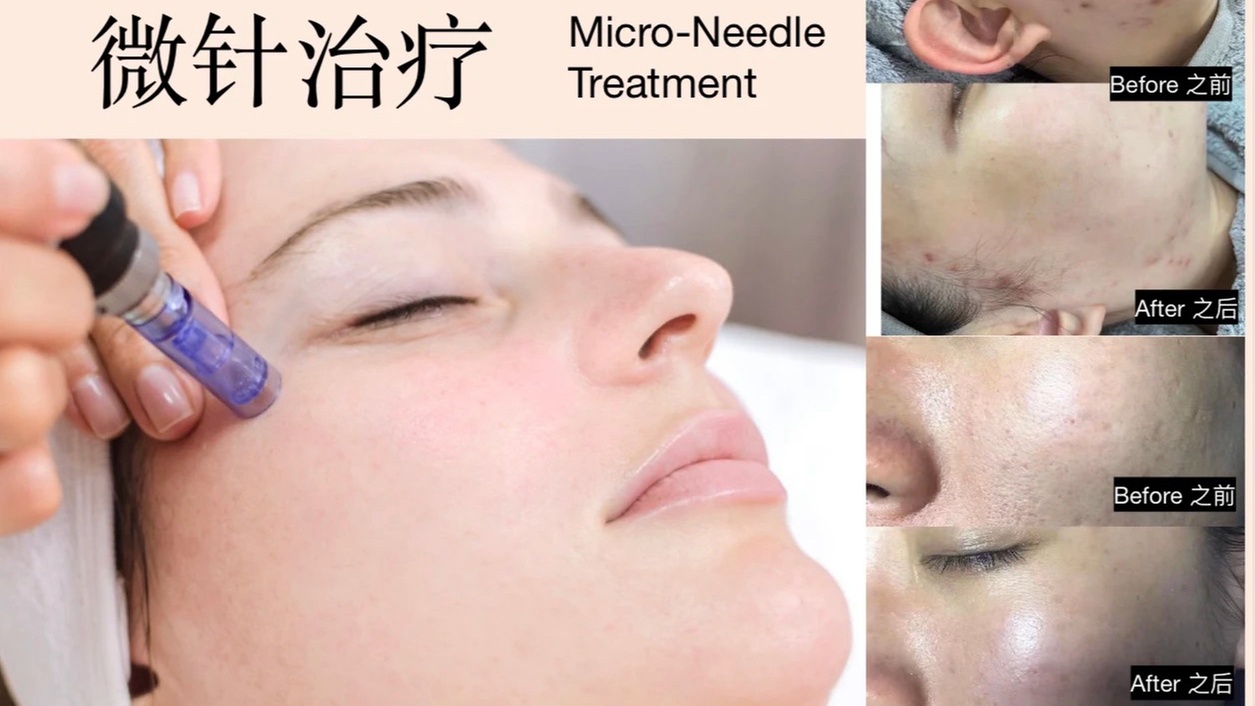 Collagen-Boosting Micro-needling with PRP at OSP Medical Spa