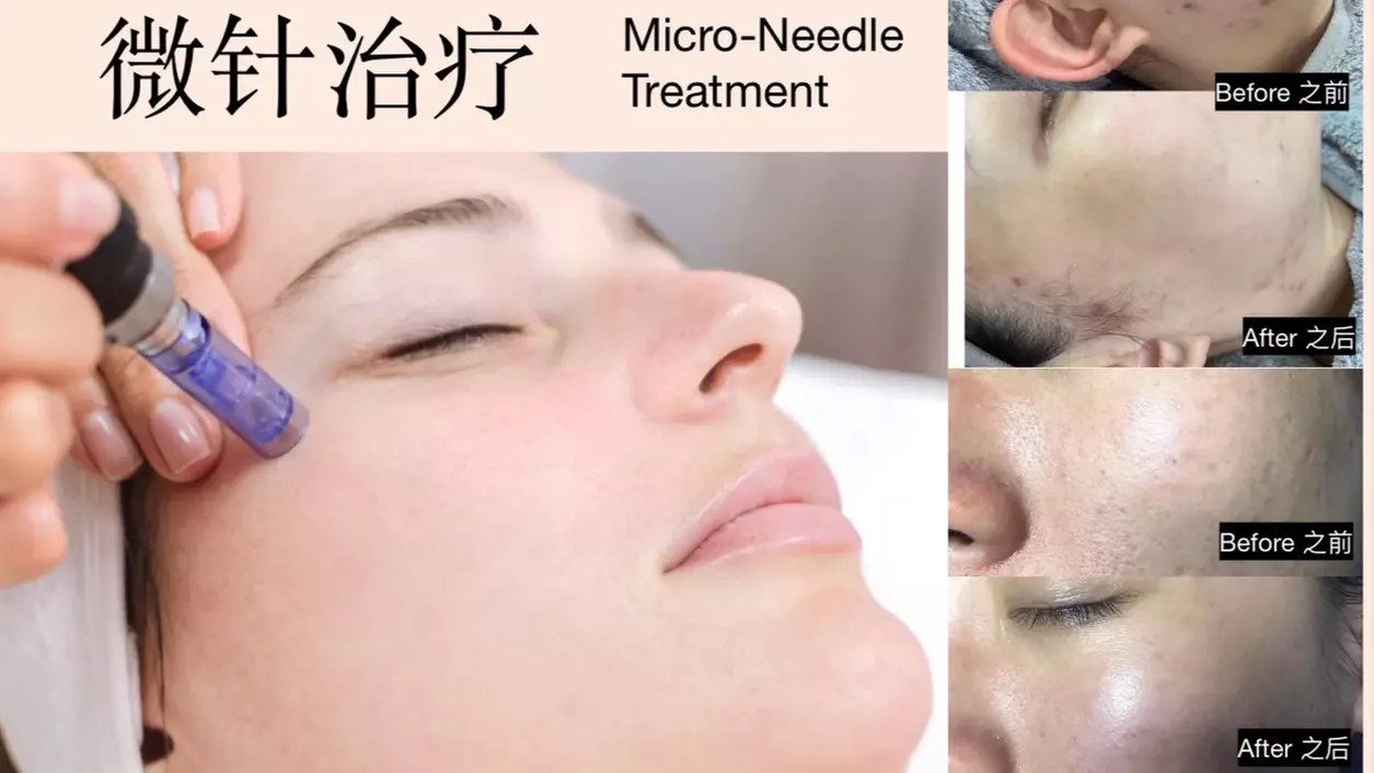 Unlock a radiant glow with Our Secret Place Medical Spa's micro-needling options, rejuvenating skin up to 80% - Primary Image