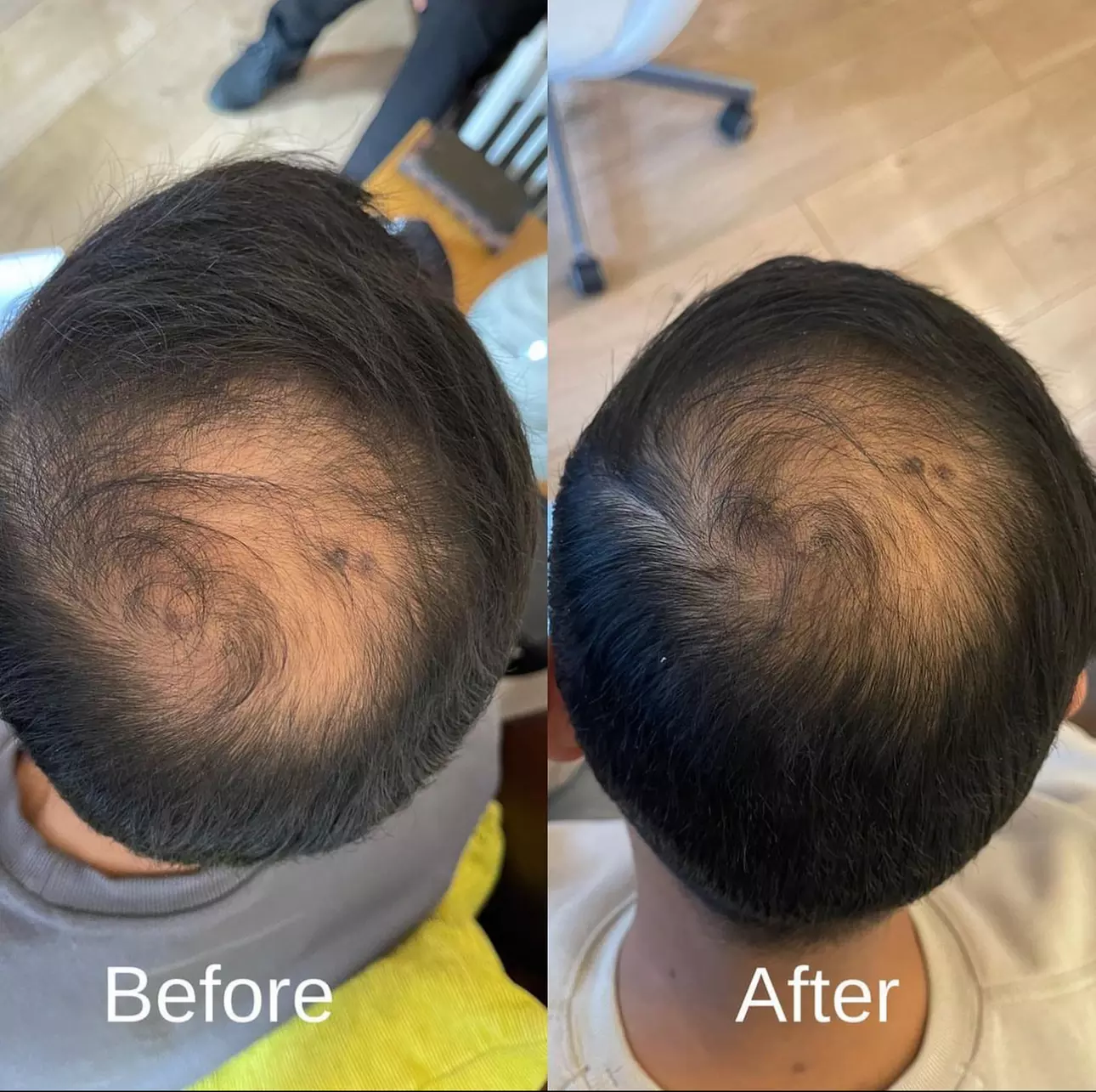 PRP / Platelet Rich Plasma / Vampire at Dr S Aesthetics