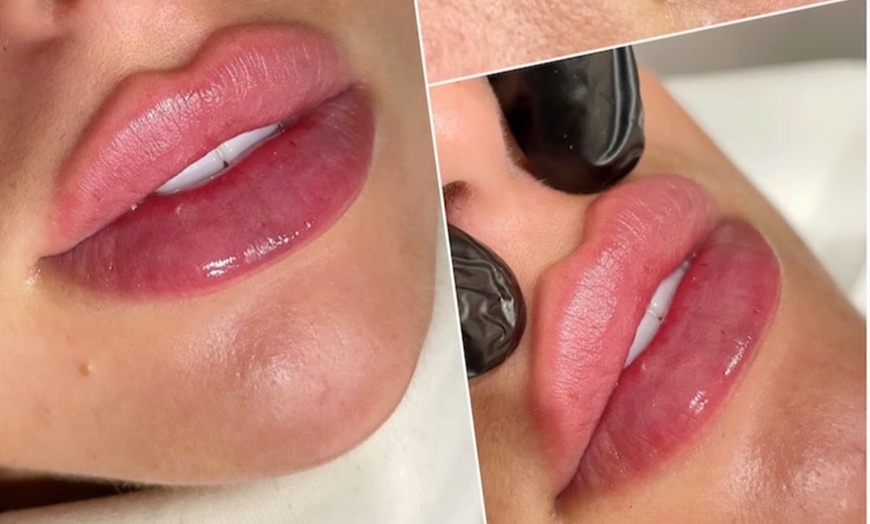 Image 2: Restylane Kysse Lip Filler or Dysport Units 