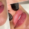 Image 2: Restylane Kysse Lip Filler or Dysport Units 