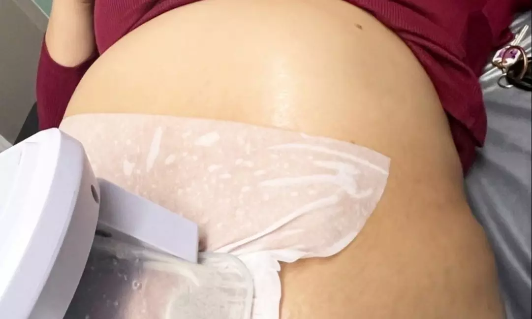 1, 3 or 5 UltraSlim IV Radio Frequency Skin Tightening Treatment for 1