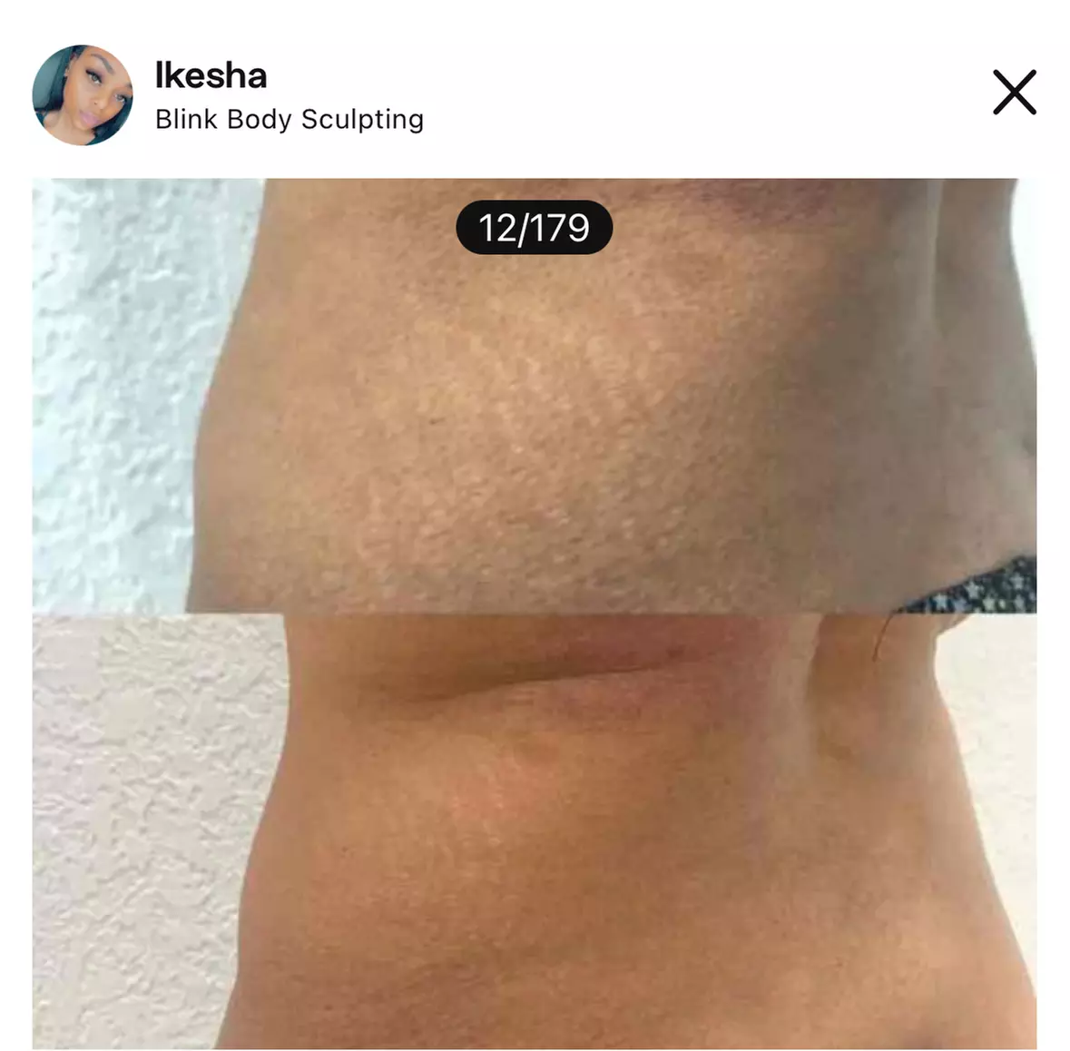Up to 30% At Blink Body Sculpting, Get a Stretch Mark or Scar Camouflage Tattoo with Touch Up