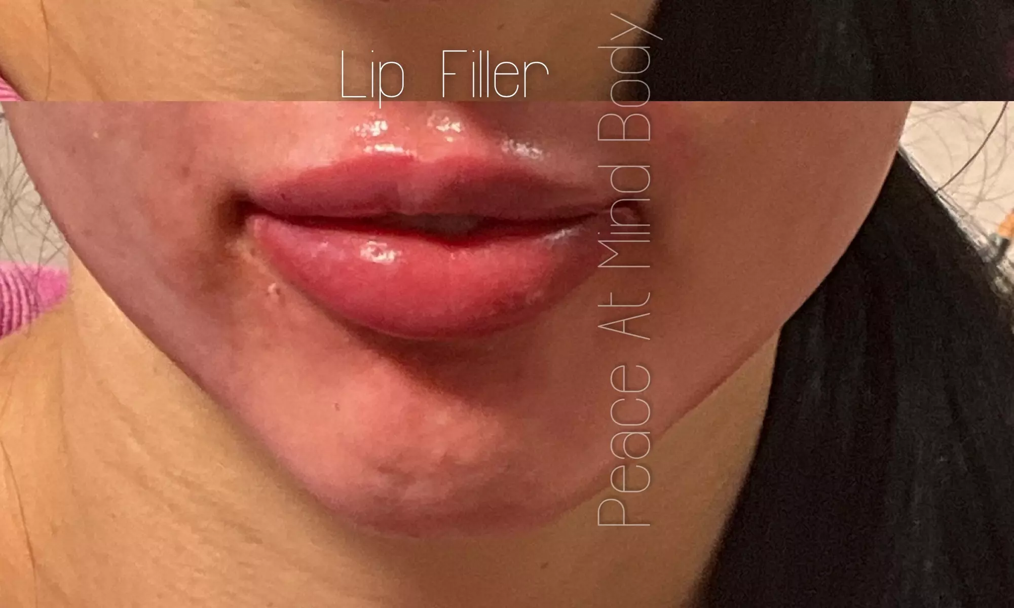 Up to 36% Off on Injection - Hyaluronic Acid at Peace mind body beauty - Primary Image