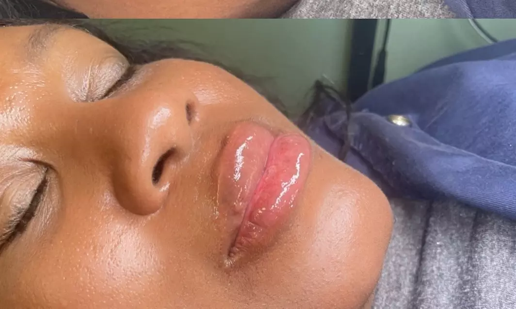 Up to 30% Off on Injection - Dermal Filler at Exotikiss - Primary Image