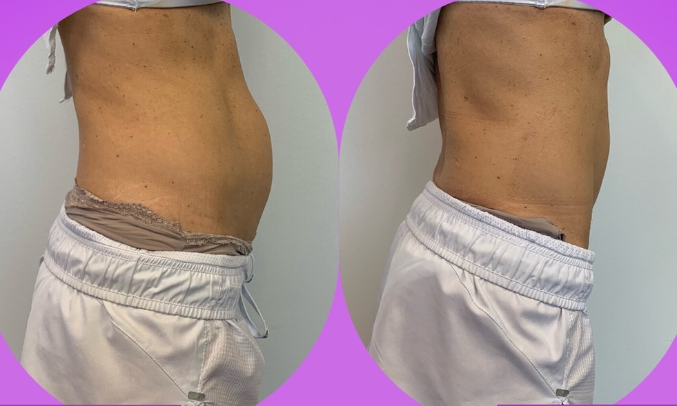 Electromagnetic sculpting for ABS, Butt, Arms, Thighs, or Calves
