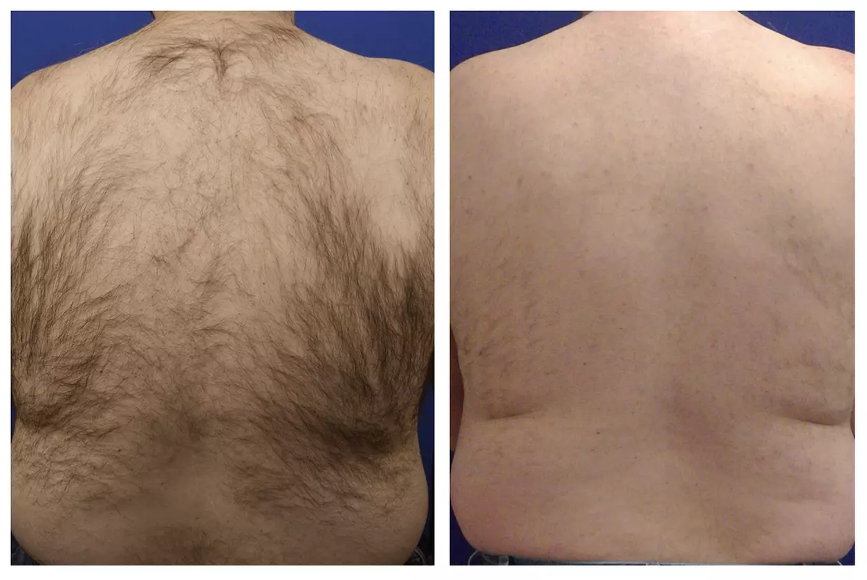 Smooth Skin with Laser Hair Removal Sessions Available