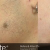 Image 2: Say Goodbye to Unwanted Hair with Six Laser Hair-Removal Sessions