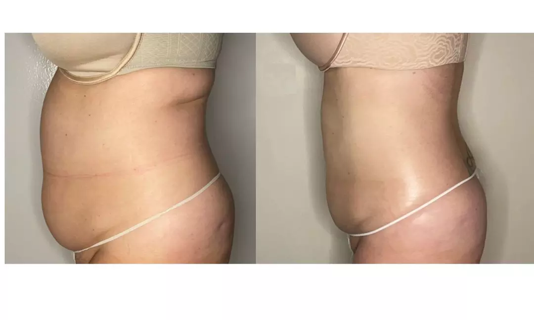 Up to 50% Off on Ultrasonic Fat Reduction at Euphoria Skin and body - Primary Image