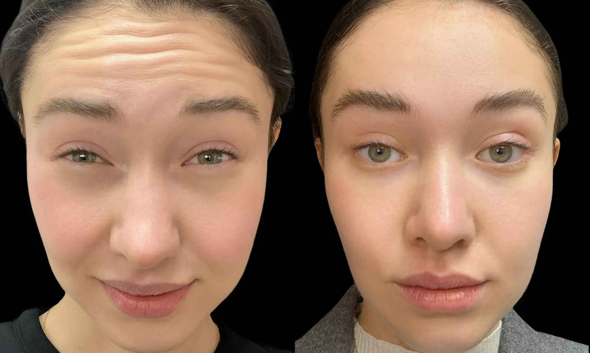 Smooth Away Lines with Botox Lip Flip, 20 or 40 Units of Botox