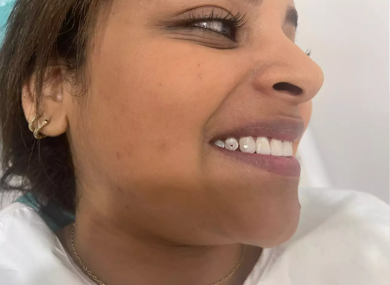 Up to 41% Off on Teeth Whitening at Naty esthetic & spa - Primary Image