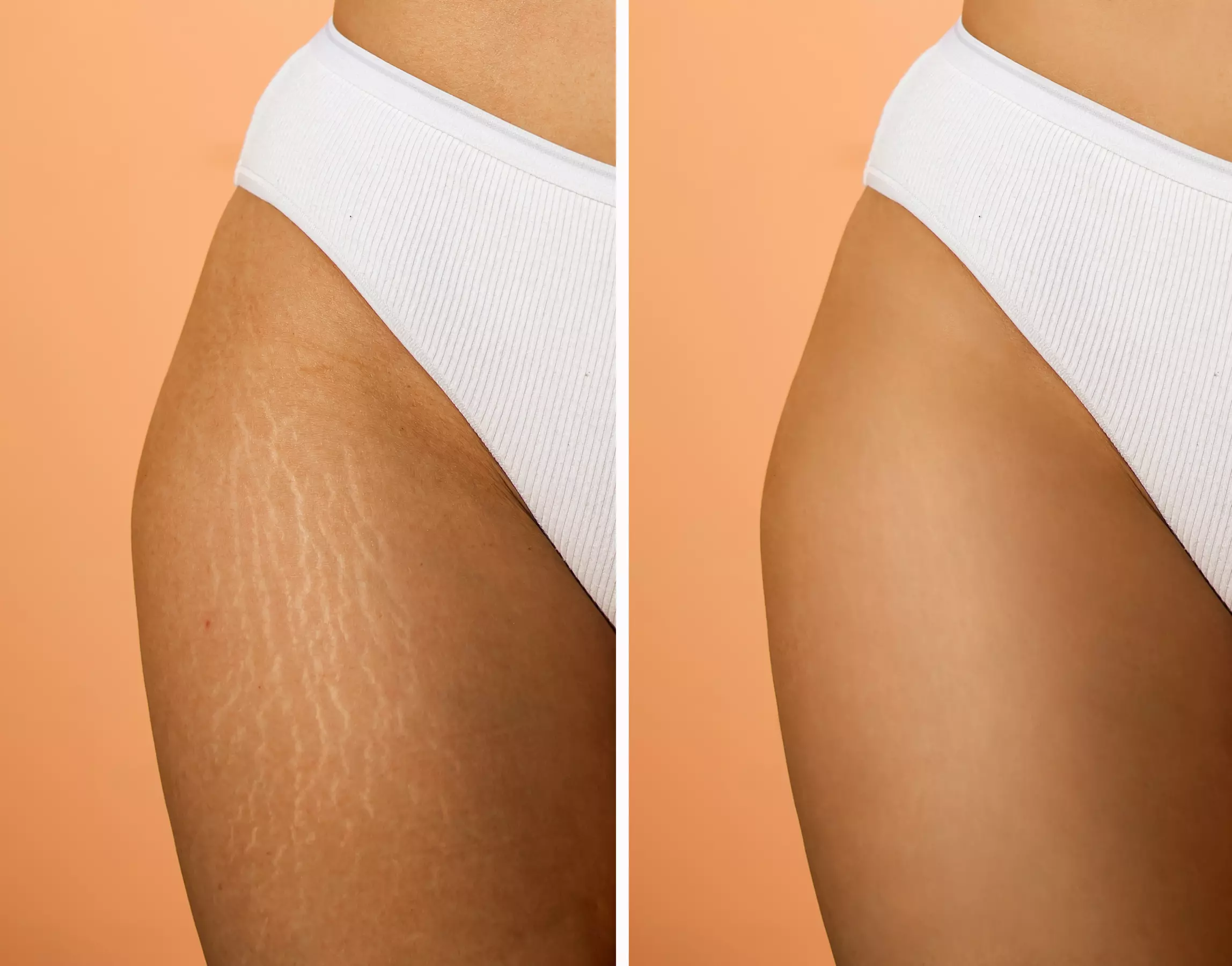 Up to 50% Off on Tattooing at Utah Stretch Mark Lab - Primary Image