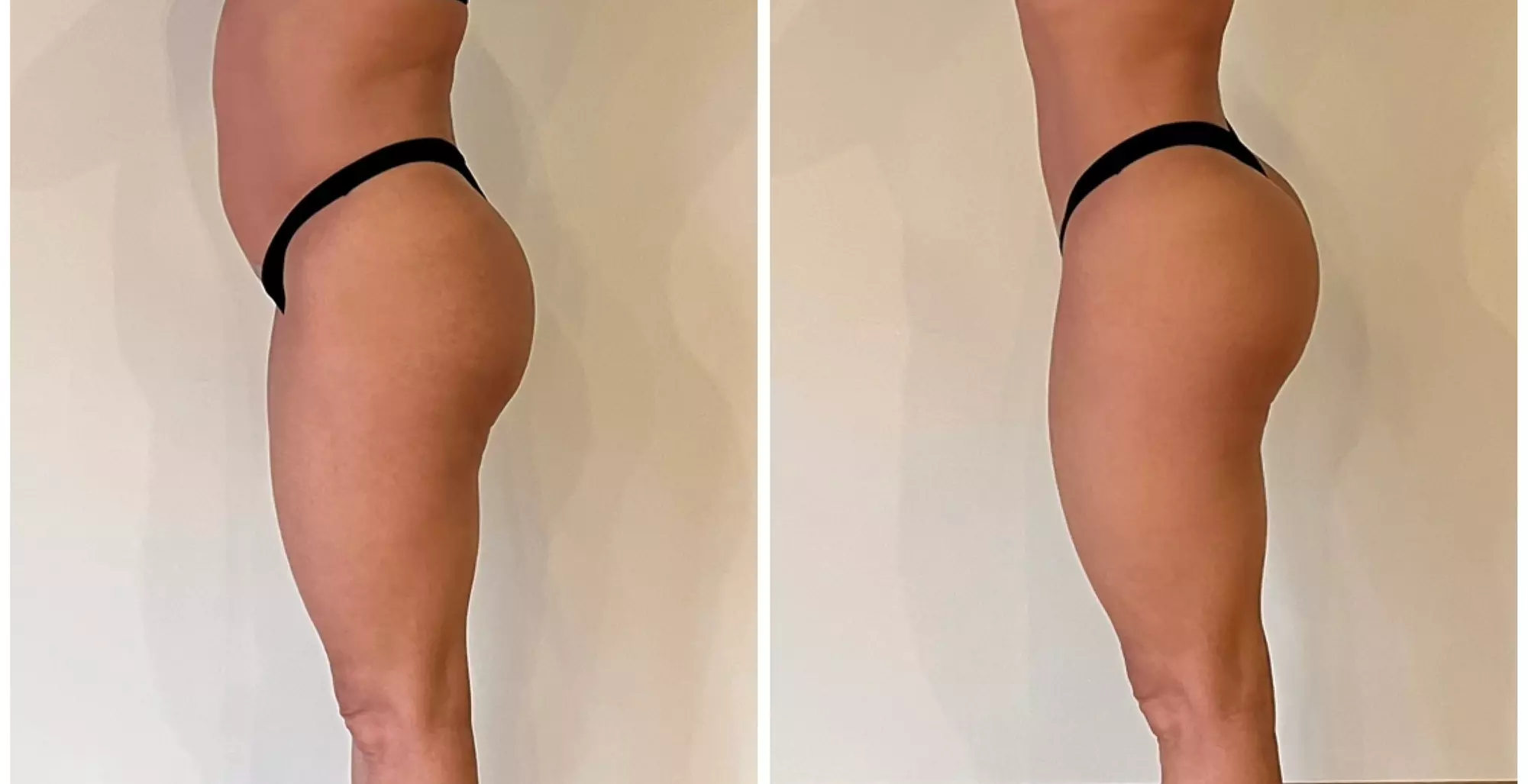Experience a Brazilian Butt Lift with EMS Technology