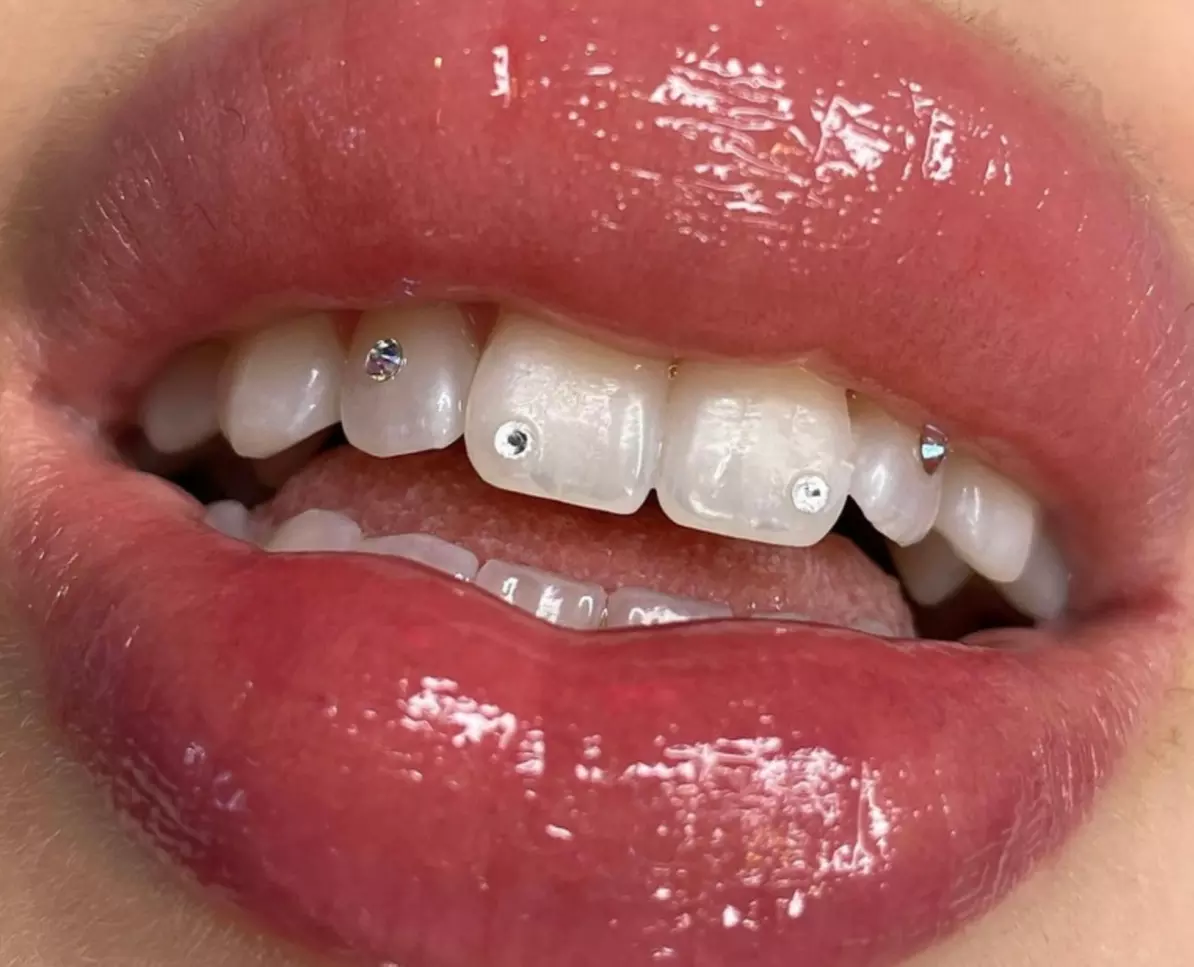 Up to 33% Off on Teeth Whitening