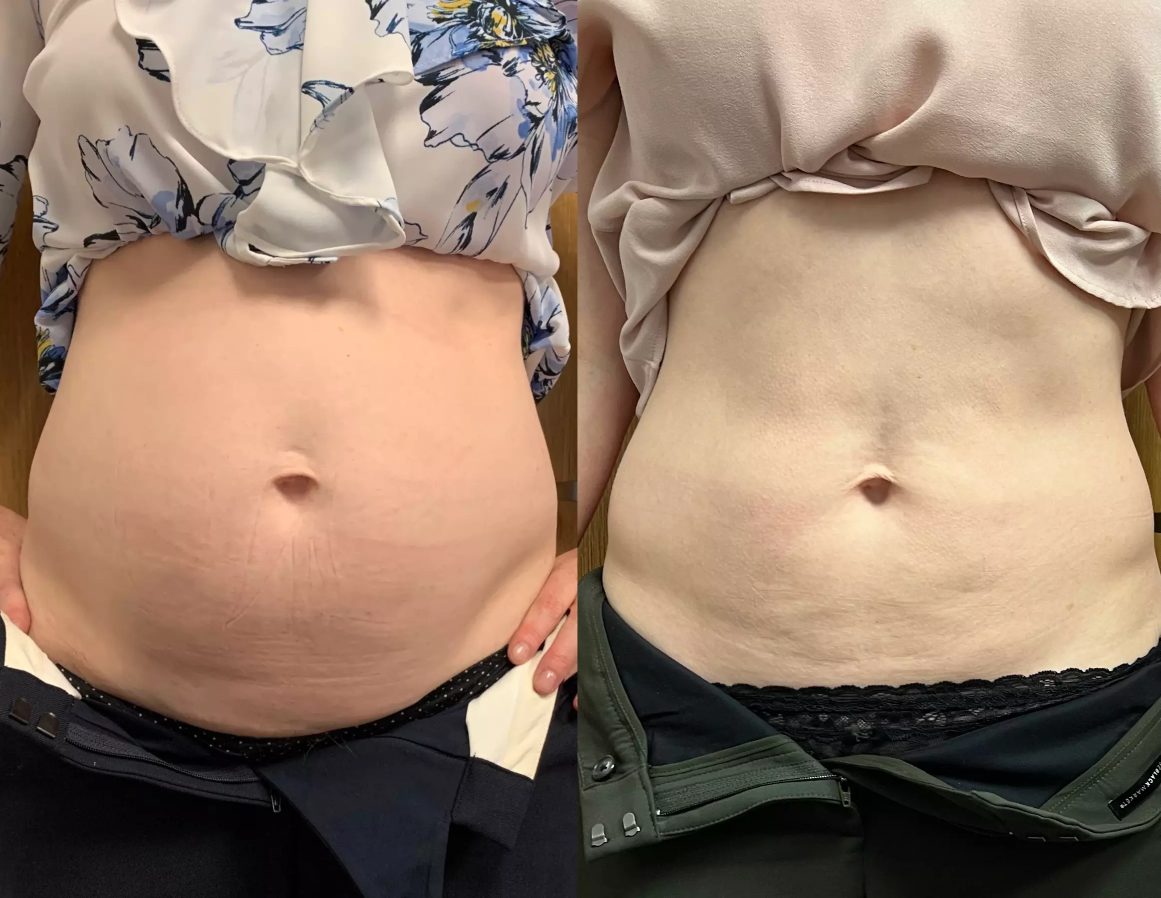 One session of Electromagnetic Sculpting for muscle toning