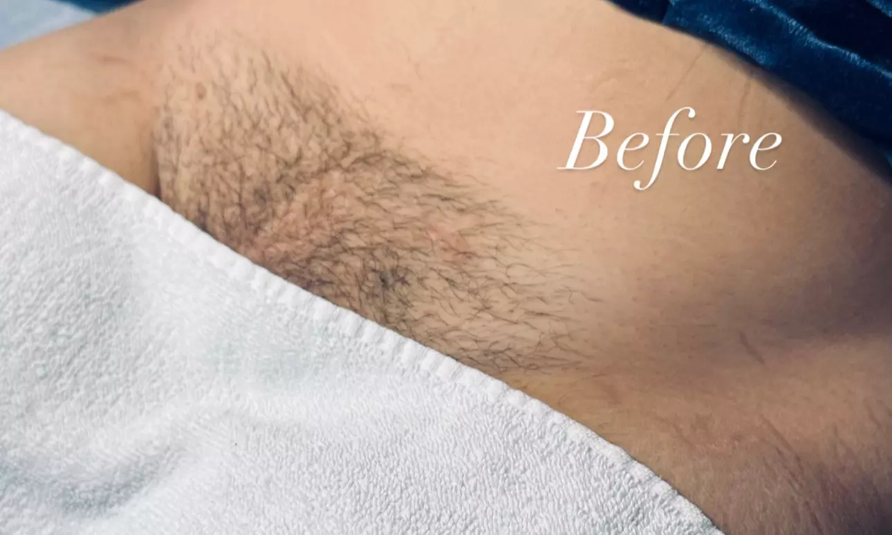 Experience up to 54% off at It is Wellness Holistic Health with diverse Brazilian waxing options for smooth results - Second Medium