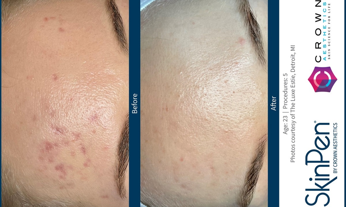 Up to 30% Off on Microneedling at Northshore Health and Beauty