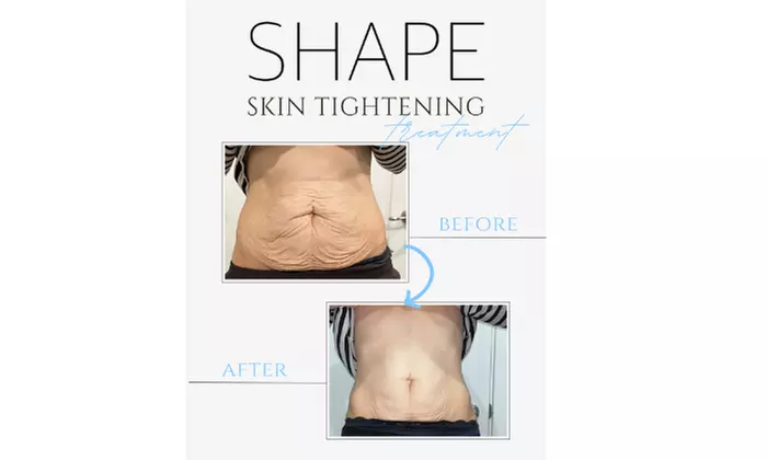 Non-Invasive Skin Tightening Treatments for a Toned Look
