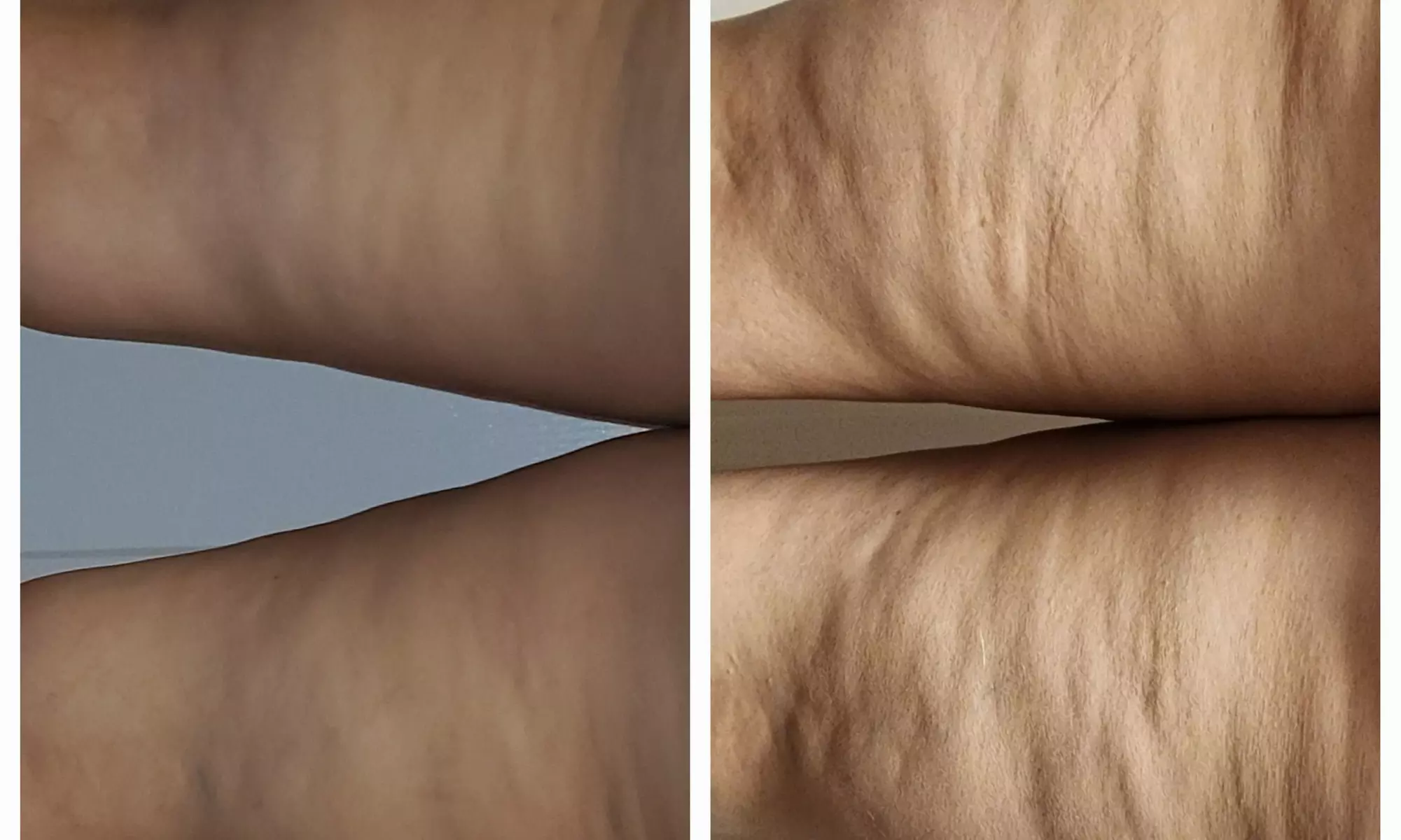 Fat or Cellulite Reduction Using Cryo Tshock at All About You Spa