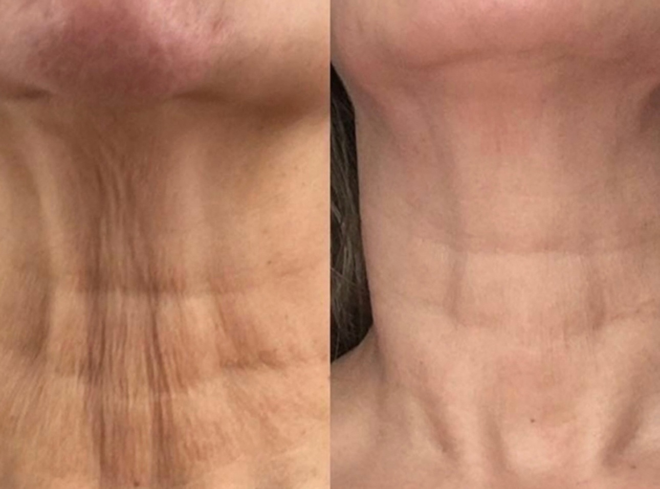 Fibroblast Plasma Pen Lifts for Face and Neck