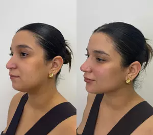 ¡Reafirma tu rostro! Infiltración de 1 o 2 viales de tratamiento de relleno dérmico en 1 zona a elegir para 1 persona