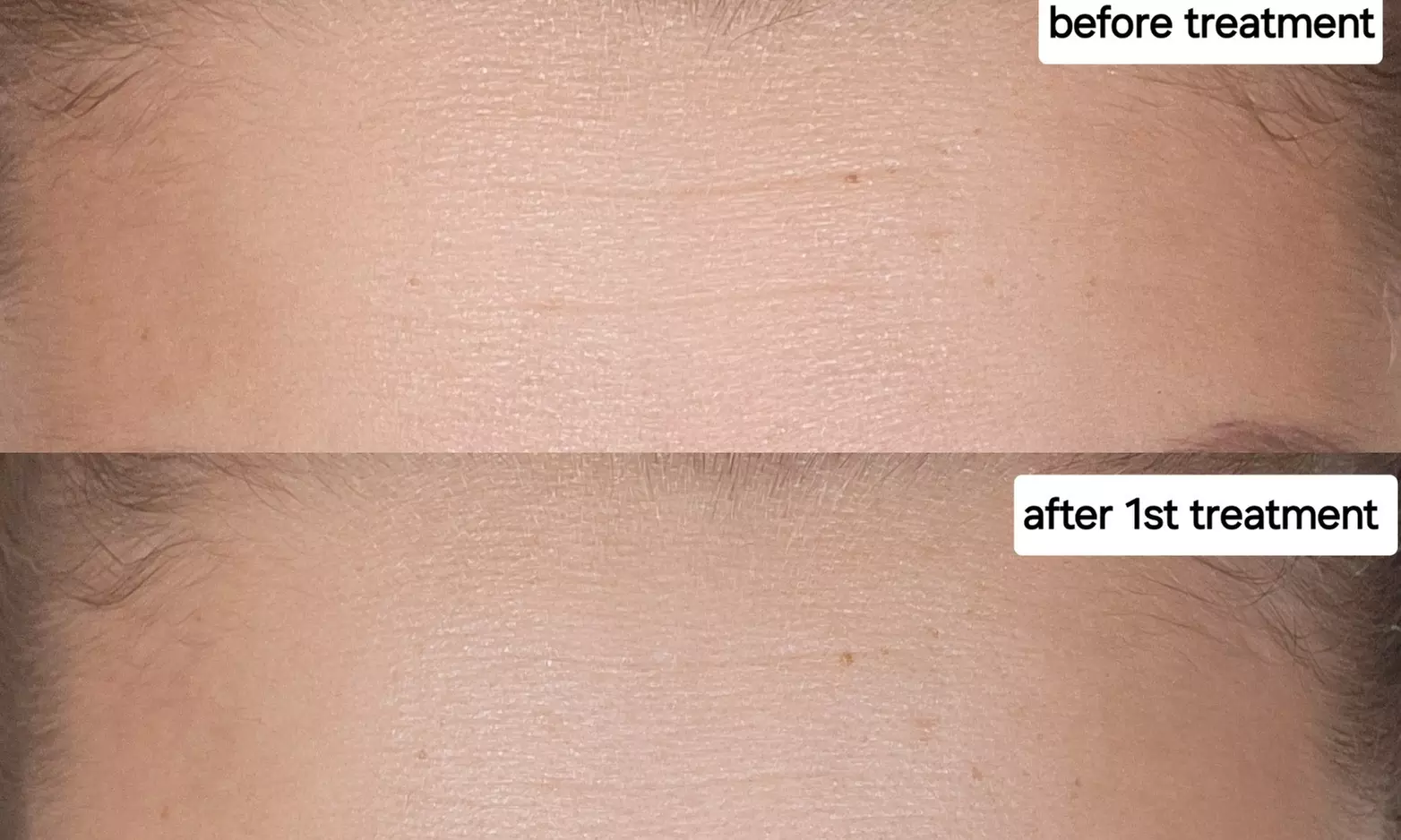 Revitalize with Two Fine Line and Wrinkle Treatments using Microneedling (Up to 40% Off) - Second Medium