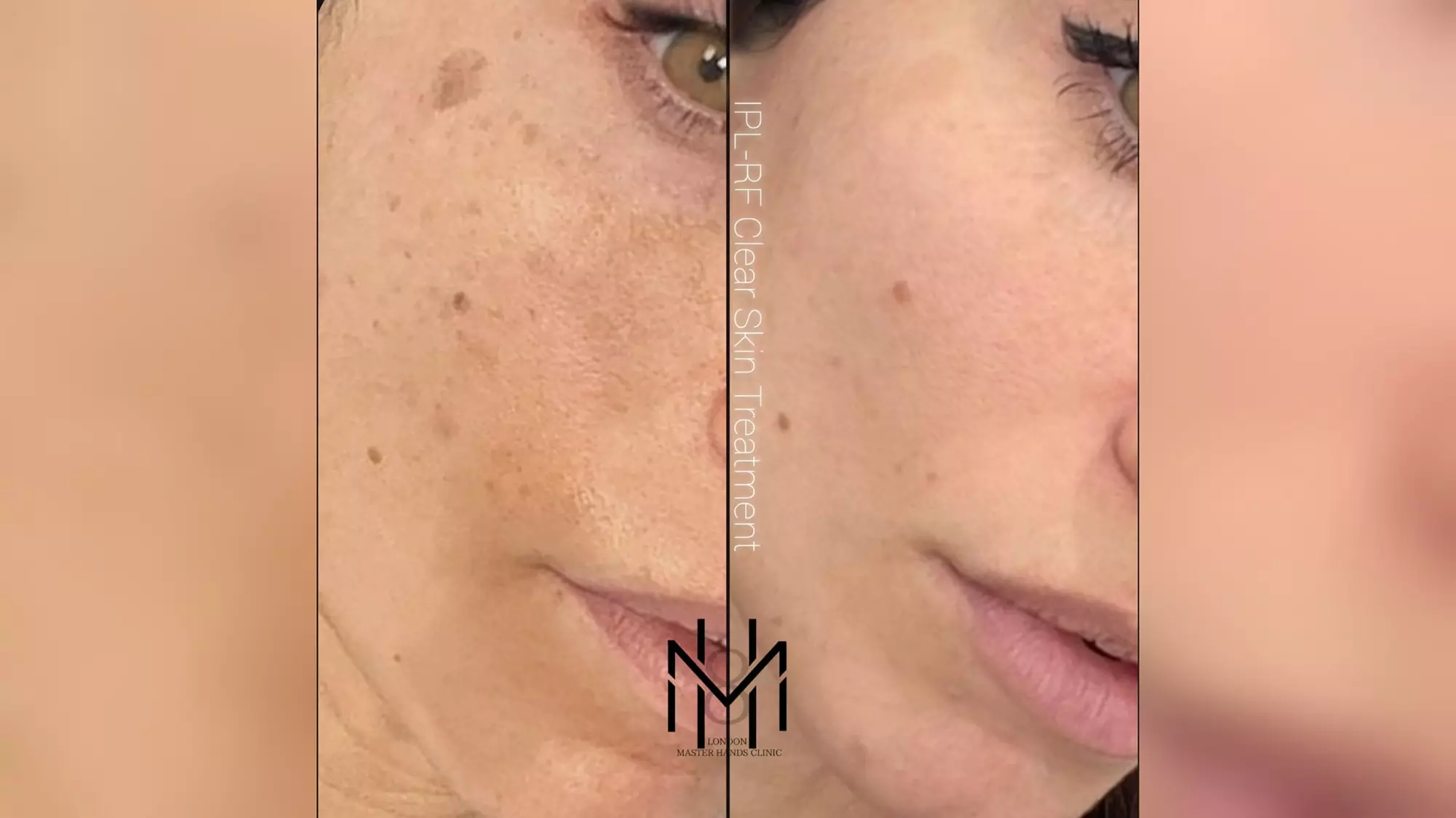 Up to 66% Off on Facials -  IPL