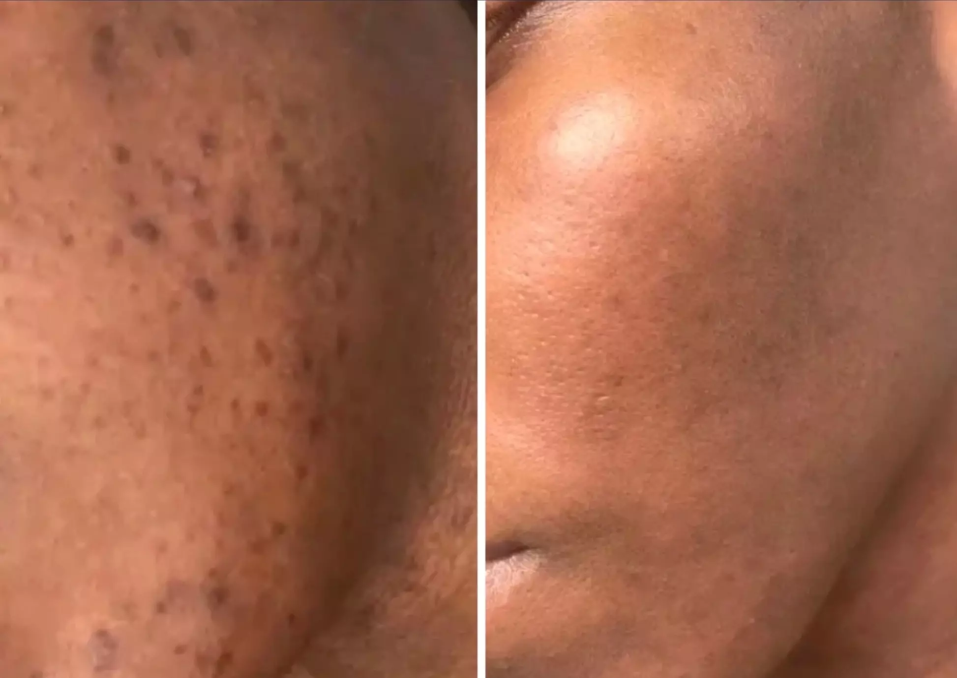 Up to 69% Off on HydraFacial at Skin & Laser Aesthetics