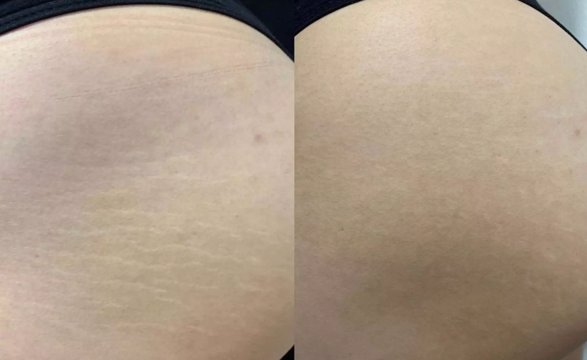 Up to 50% Off on Tattooing at Utah Stretch Mark Lab - Second Medium